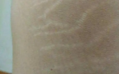 健美选手生长纹